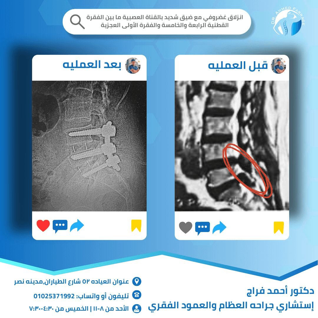 إنزلاق غضروفي مع ضيق شديد بالقناة العصبية