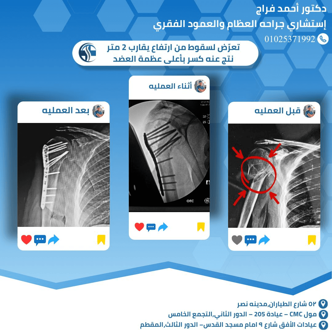 تعرّض لسقوط من ارتفاع يقارب 2 متر نتج عنه كسر بأعلى عظمة العضد