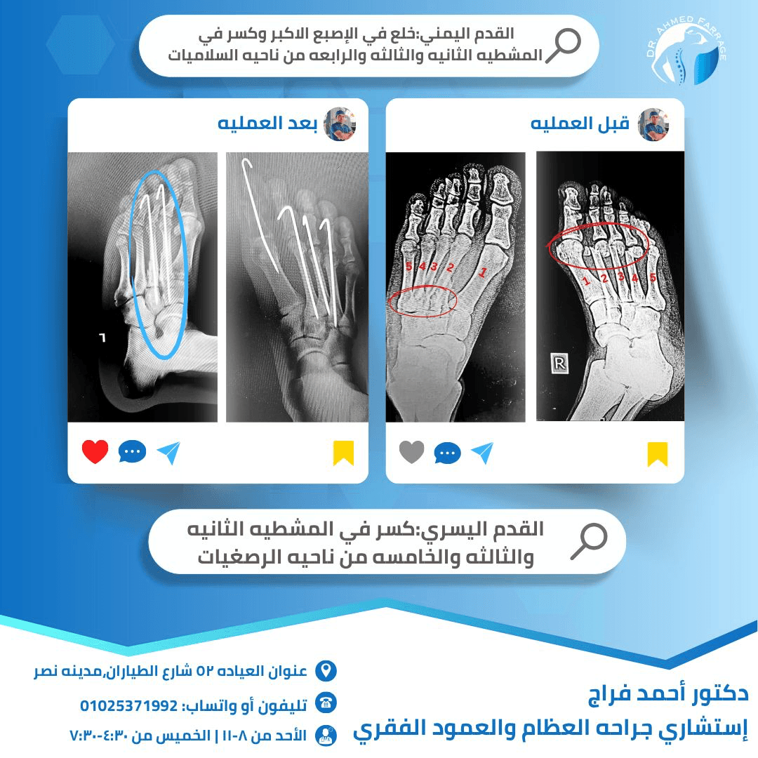 خلع في الإصبع الأكبر وكسر في المشطيه من ناحيه السلاميات