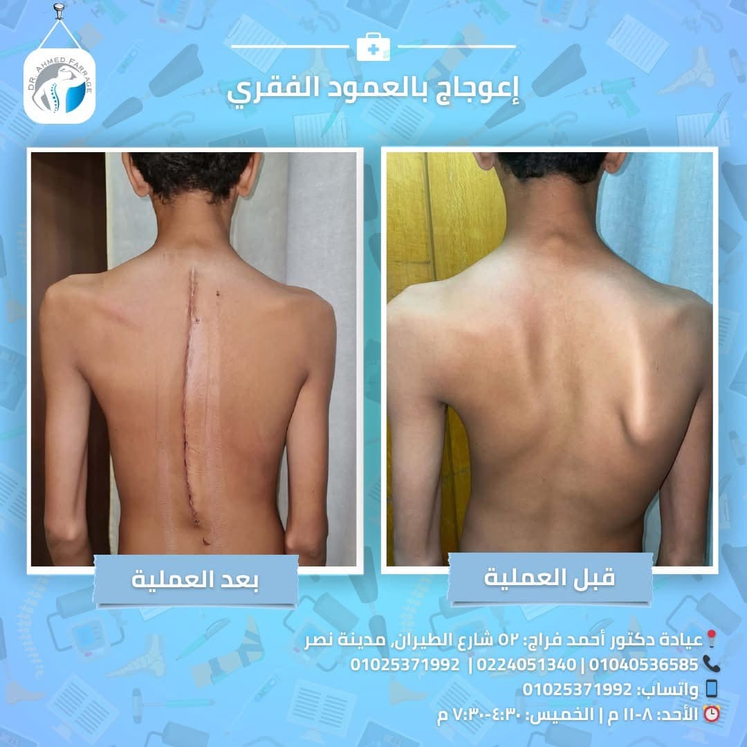 إعواجاج بالعمود الفقري