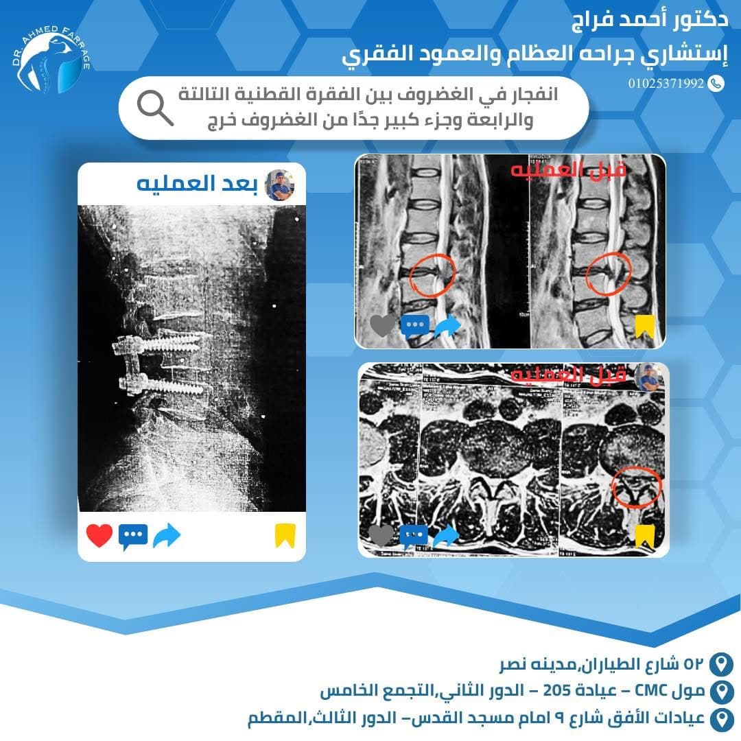 إنفجار في الغضروف