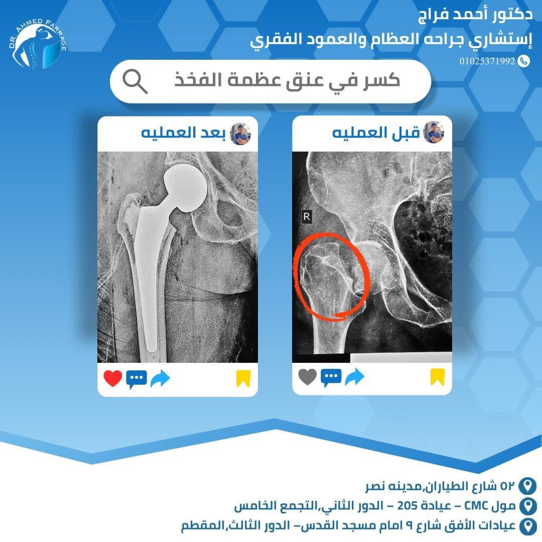 كسر في عنق عظمه الفخذ
