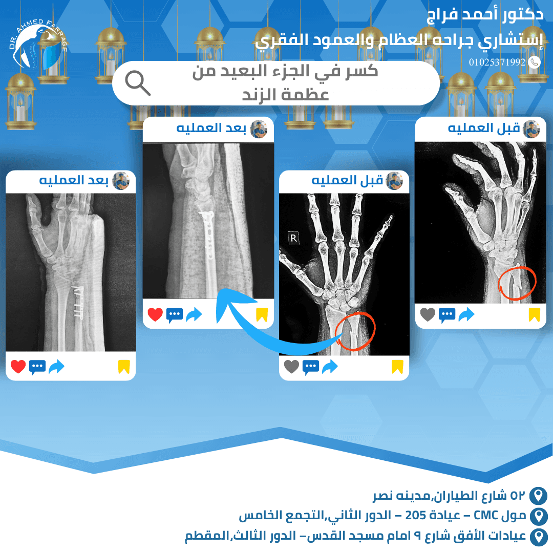 النجاح مش بس إن العظمة تلتئم… النجاح الحقيقي إن المريض يرجع طبيعي وواثق في نفسه 💙