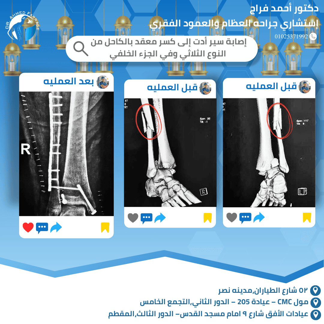المريض (28 سنة) تعرض إلى كسر معقد بالكاحل من النوع الثلاثي