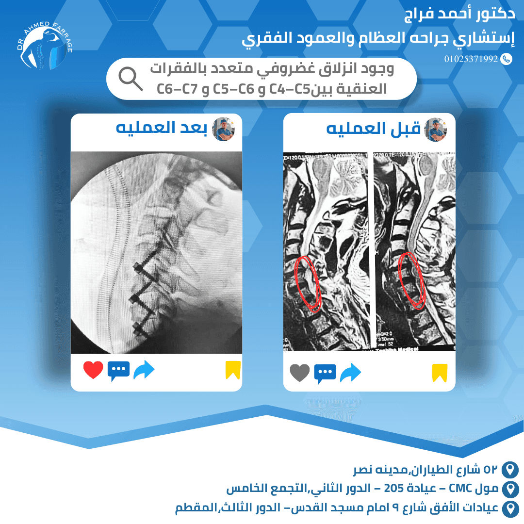 وجود انزلاق غضروفي متعدد بالفقرات العنقية بينC4–C5 و C5–C6 و C6–C7